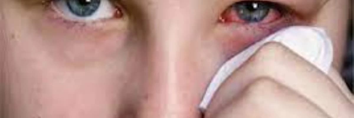 Allergik konyuktivit (pollinoz)