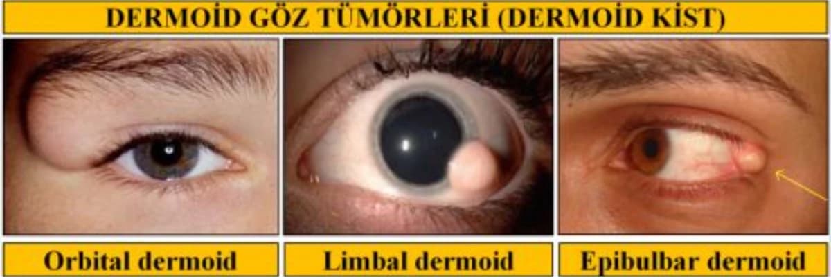 Göz şişləri: Göz sağlamlığını təhdid edən anormal böyümələr