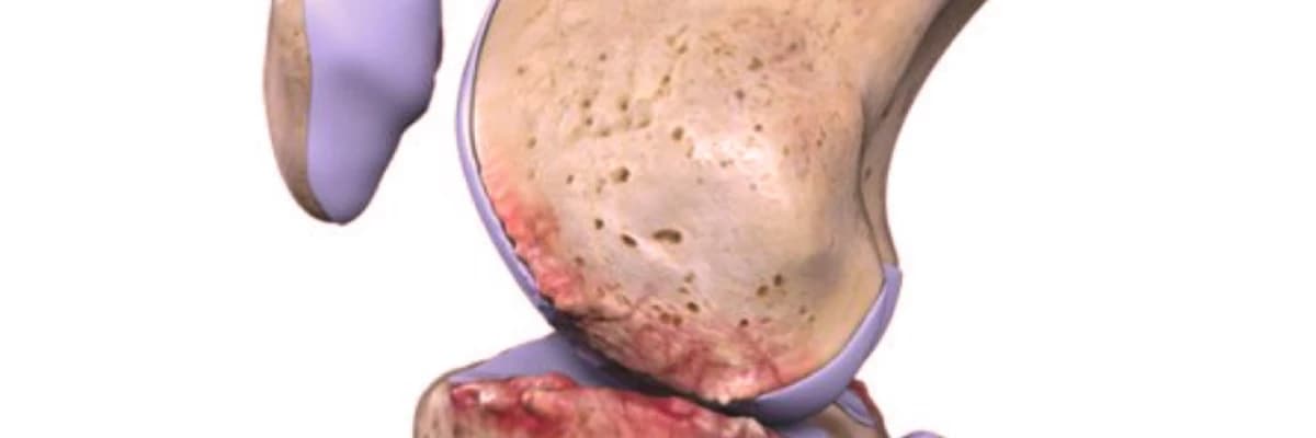 Osteoartrit