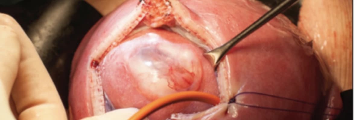 Fetal cərrahi müdaxilələr