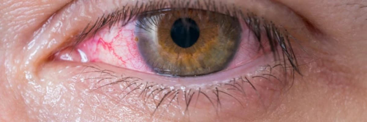 Quru goz sindromundan kim eziyyet cekir