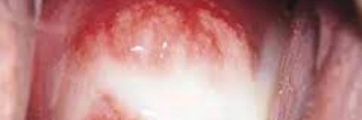 Qadinlarda xlamidioz