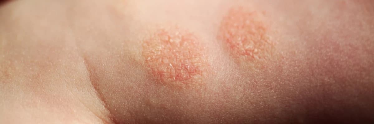 Allergik dəri xəstəlikləri (atopik ekzema, kontakt ekzema, kosmetik allergiya)