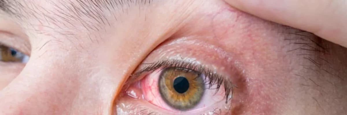 Lakrimal kanal tıkanıklığı: səbəbləri, simptomları və müalicəsi