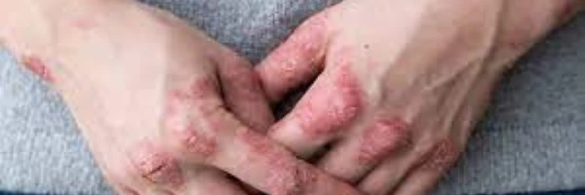 Psoriatik artrit