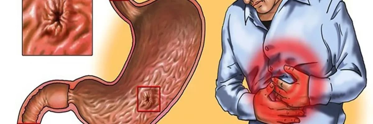 Qastrit: mədə iltihabı və simptomları