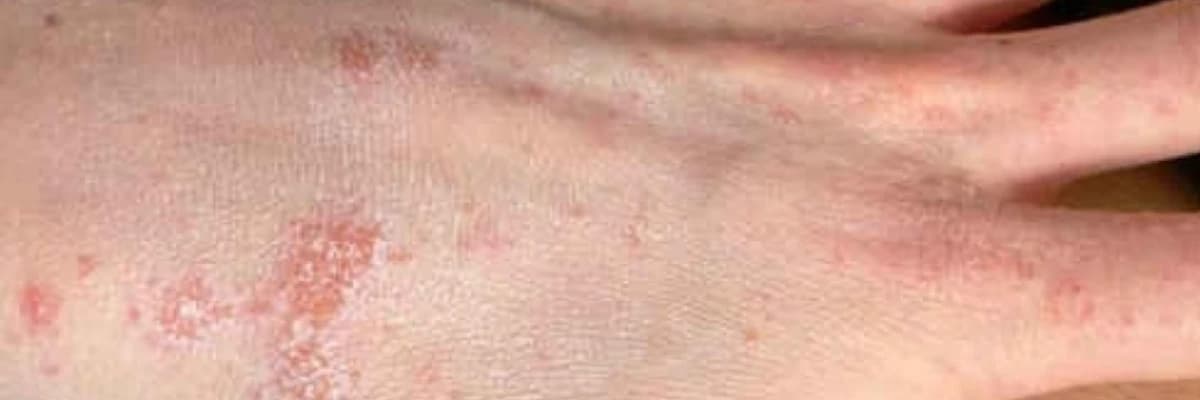 Qotur: Önəmli Bir Viral Xəstəlik