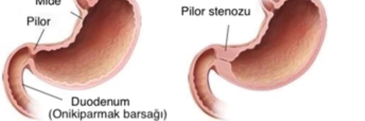 Uşaqlarda pilor stenozu: İlk 3 ayda qusma səbəbləri,Mədə çıxışı darlığı