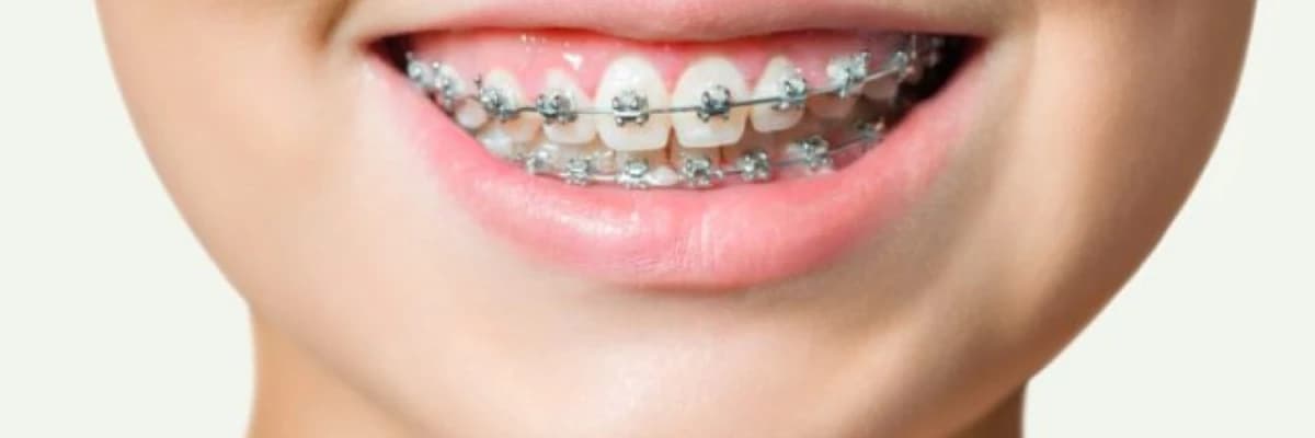 SABİT MEXANİKA İLƏ ORTODONTİK MÜALİCƏ