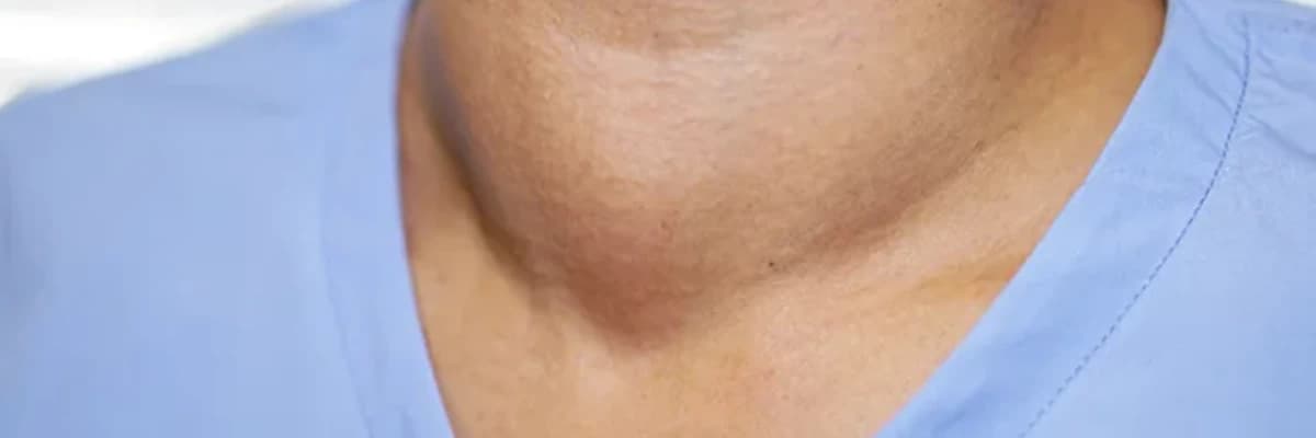 Hipertiroid xesteliyi