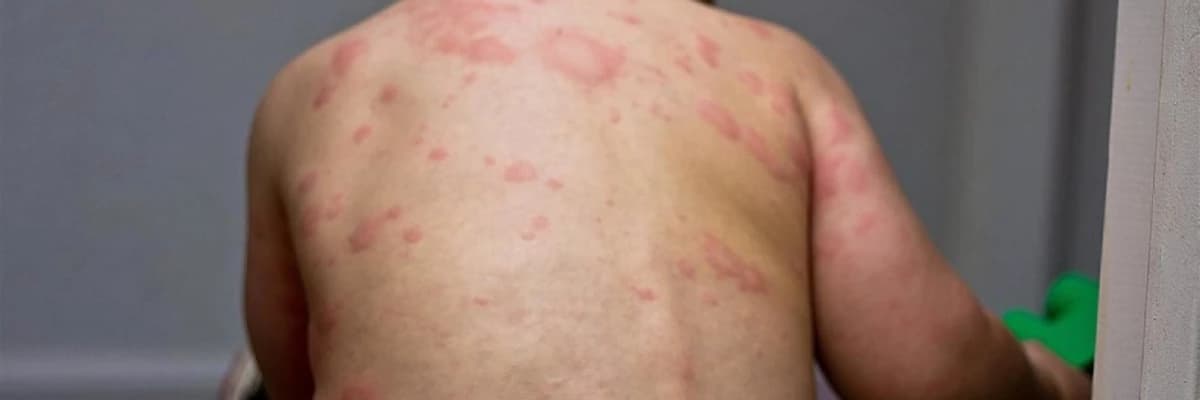 Roseola infantum (Altıncı Xəstəlik)