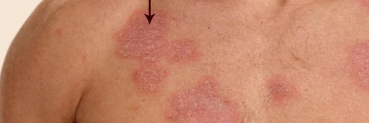 Revmatizmal dəri xəstəlikləri (Qırmızı qurdeşənəyi)