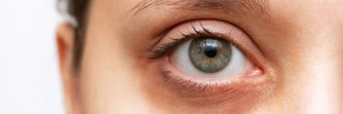 Gözlər altındakı çürüklər