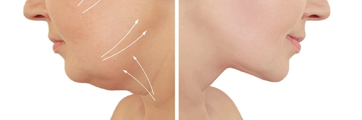 Boyun və Üz Liftinqi