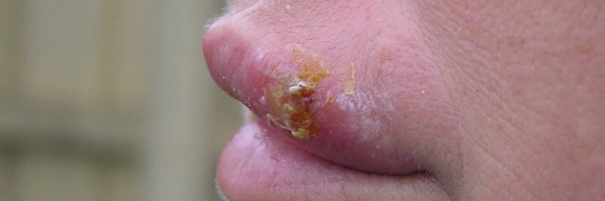 Herpes Simplex (Sadə Herpes)