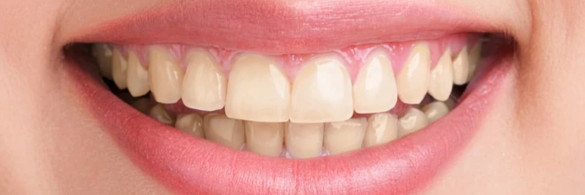 Dişlərin hər növ ağartılması