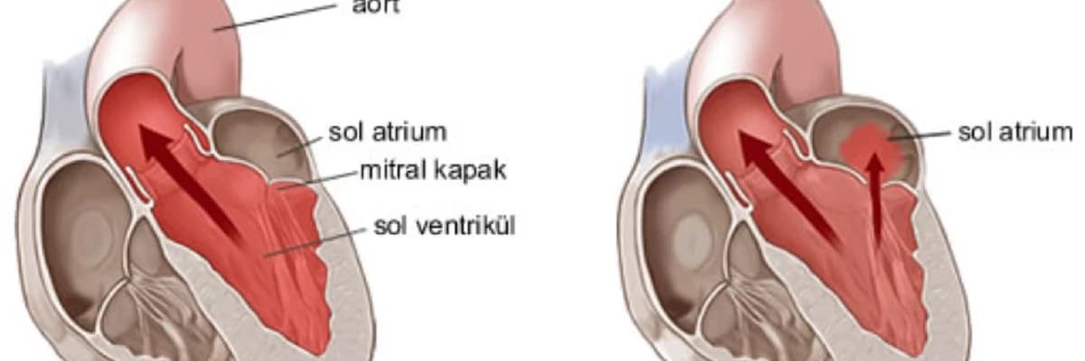 Mitral Qapaq Xəstəliyi: Ürəyin Kritik Komponentlərindən Birində Problemlər