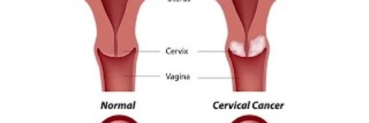 Uşaqlıq boynunda iltihabi proses (servisit)