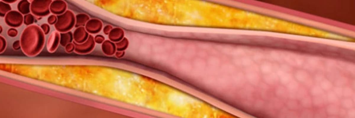Yüksək xolesterol haqqında