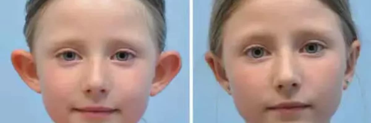 Qulaq Kulunun Estetikası Otoplastika