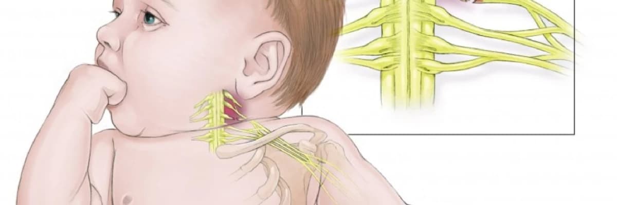 Anadangəlmə qol iflici