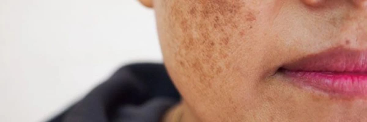 Piqmentasiya xəstəlikləri (Vitiligo, ləkələr)