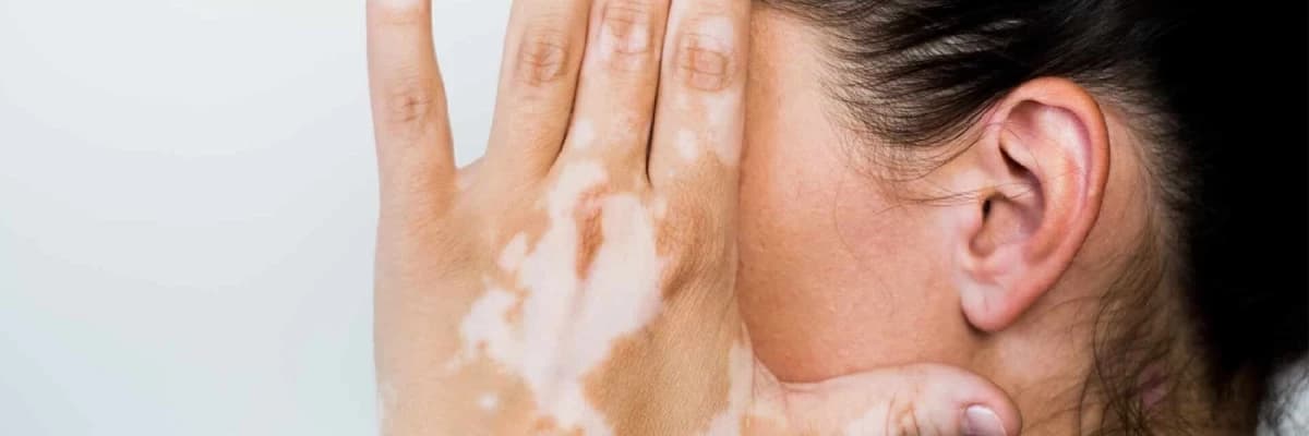 Dermatoskopik Müalicə ilə Vitiligo: Yanaşmalar və Mümkün Təsirləri