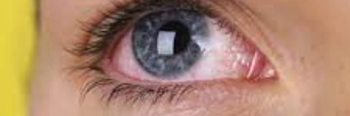 Usaqlarda allergik konyunktivit