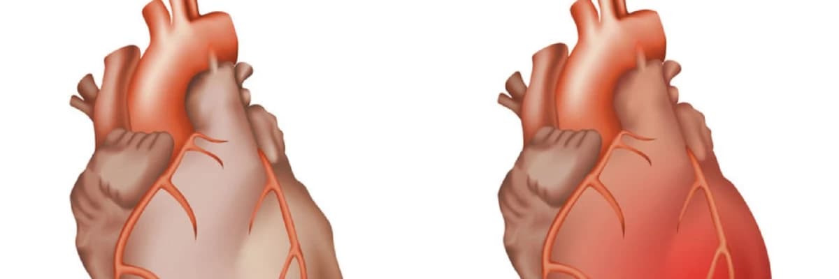 Ürək Pərdəsi İltihabı (Pericarditis): Səbəblər, Simptomlar və Müalicə