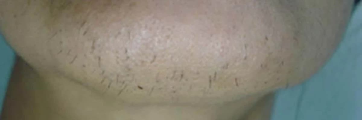 Hirsutizm