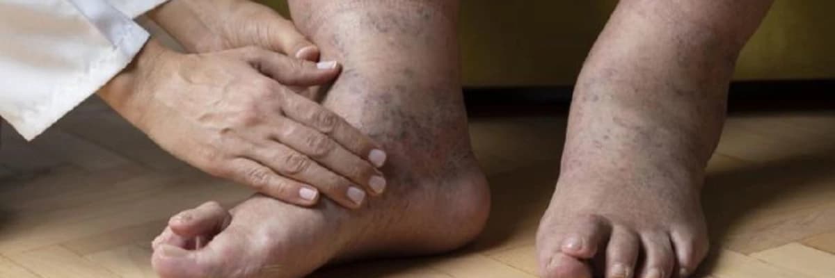 Limfedema (Lympfedema): Səbəblər, Simptomlar və Müalicə Yolları