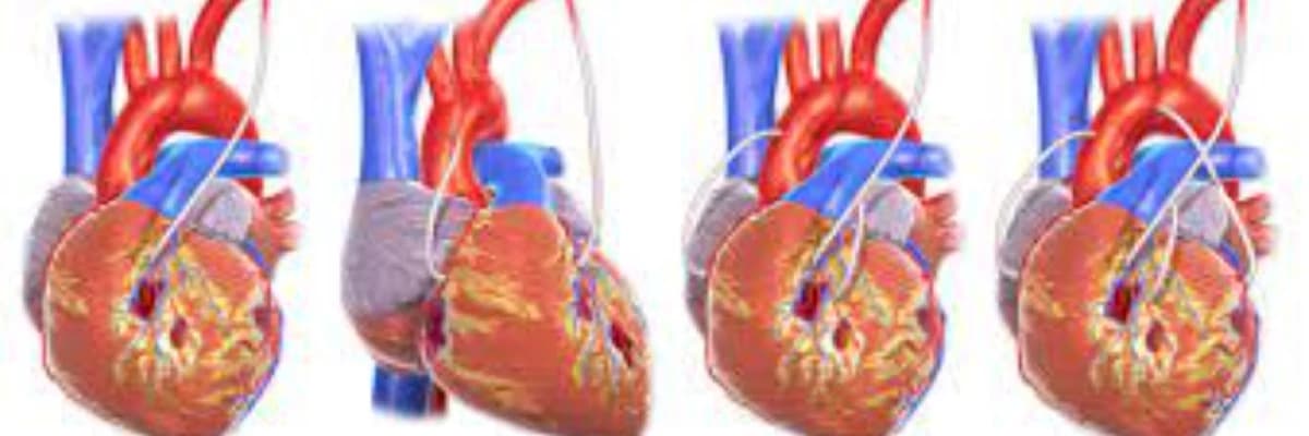 Aorto-koronar Şuntlama