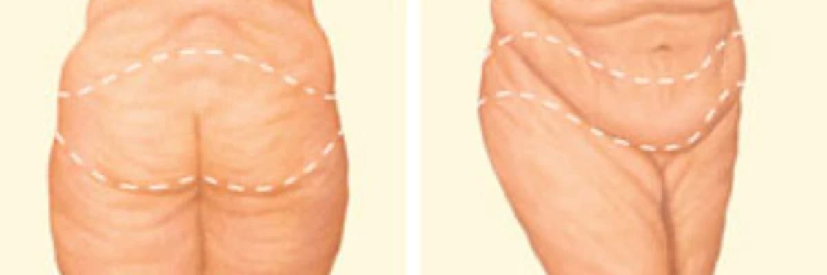 Body Lift: Estetik Cərrahiyyə dünyasının diqqətəlayiq məqamı