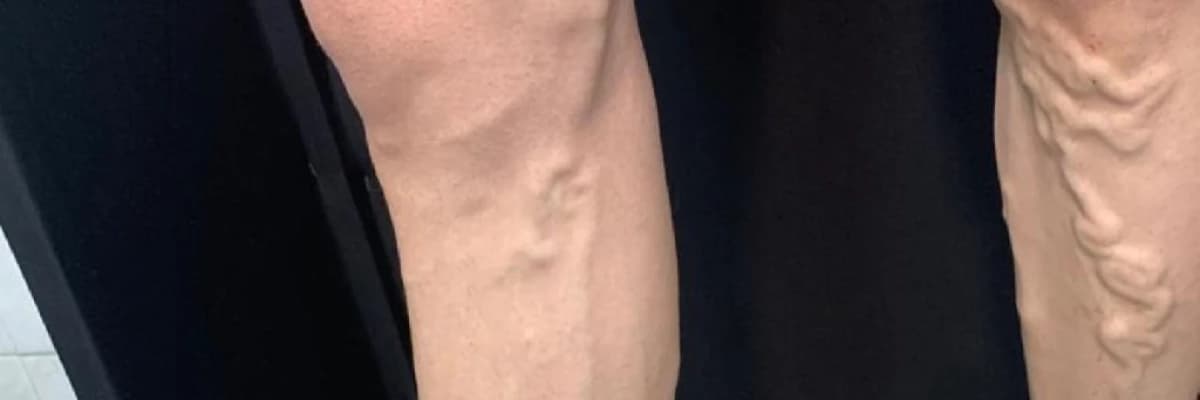 Köpüklə Varikoz Müalicəsi