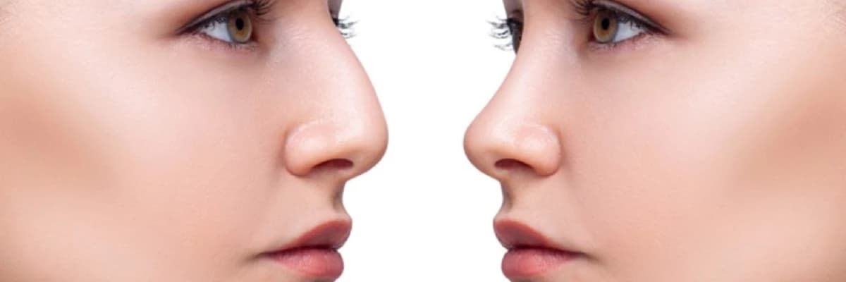 Burun estetikası - Rinoplastika nədir? Cərrahiyyə haqqında hər şey