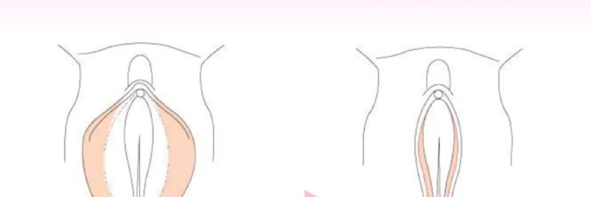 Vaginoplastika