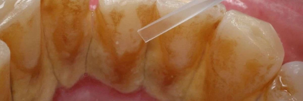 Diş Daşlarının Əmələ Gəlməsi, Təsirləri və Aradan Qaldırılması Üzrə Tövsiyələr