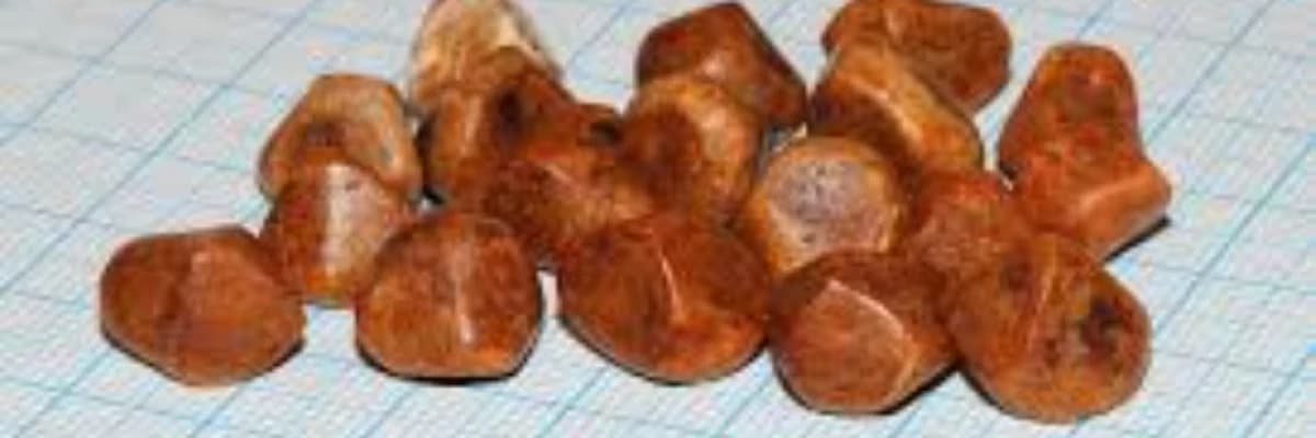 Öd kisəsində və ya öd yollarında daşların yaranması