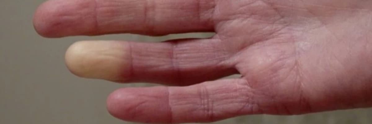 Skleroderma/ilkin sistem sklerozu