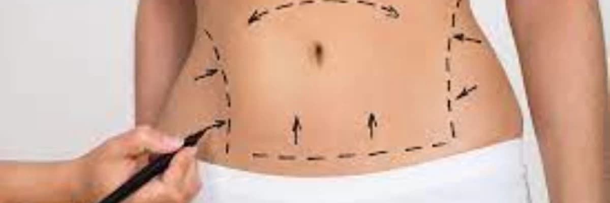 Abdominoplastika əməliyyatı