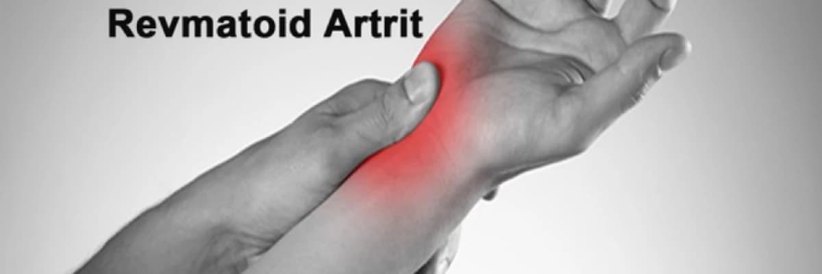Revmatoid artrit
