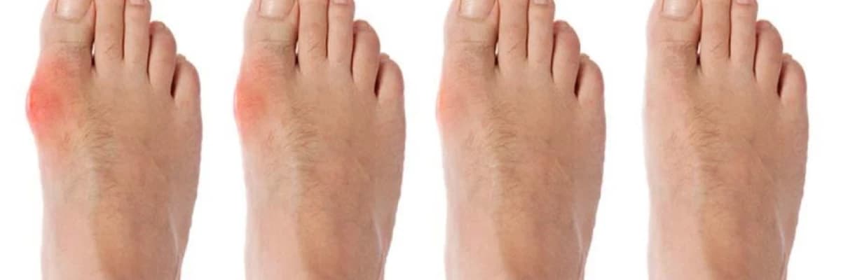 Hallux valgus