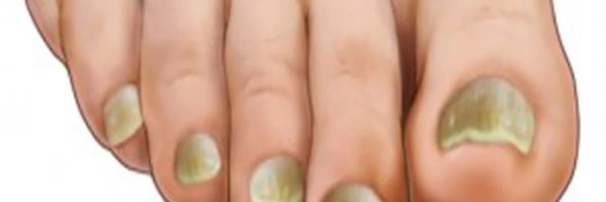 Hər növ dırnaq xəstəlikləri