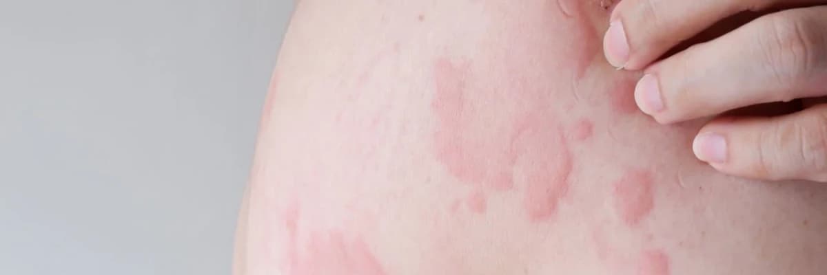 Övrə xəstəliyi və ya Urtikar (Urticaria)