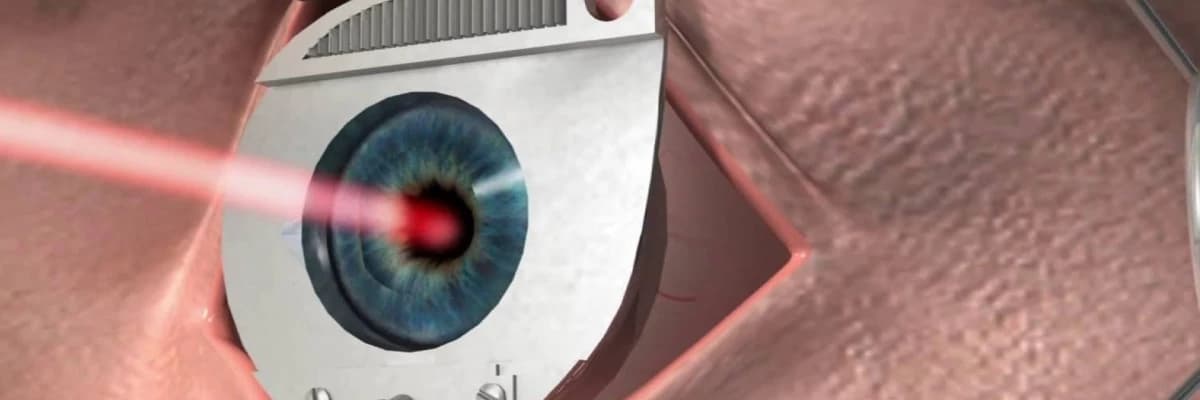 Lasik nədir, necə hazırlanır?
