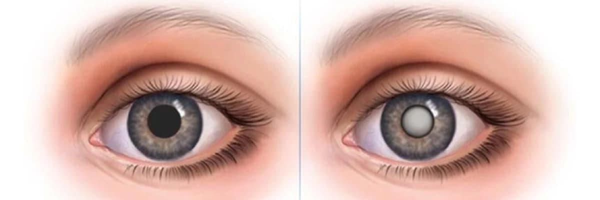 Katarakta: Gözün təbii obyektivində buludluluq