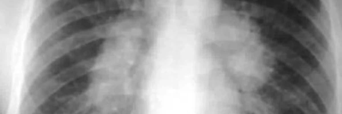 Ağciyərin sistemik xəstəliklərinin cərrahiyəsi (sarkoidoz və s.)