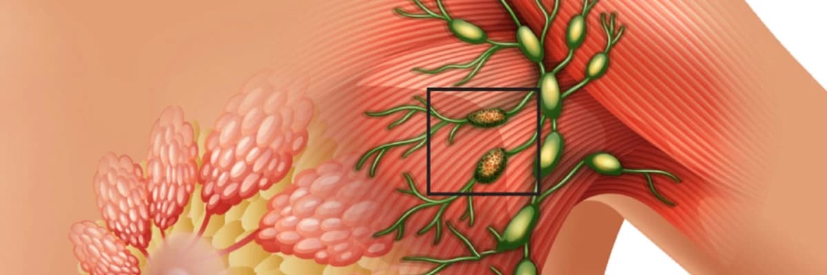 Döş xərçəngi ilə mübarizə