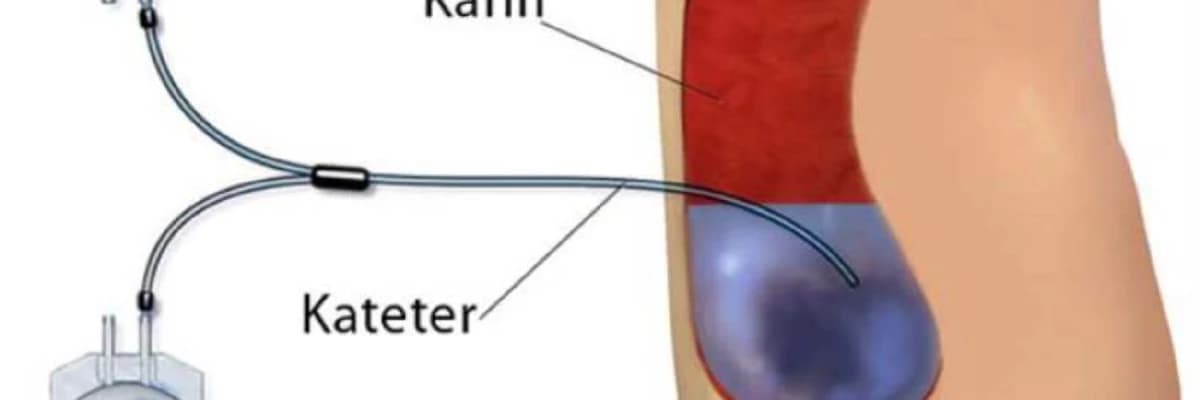 Periton dializ kateteri taxılması