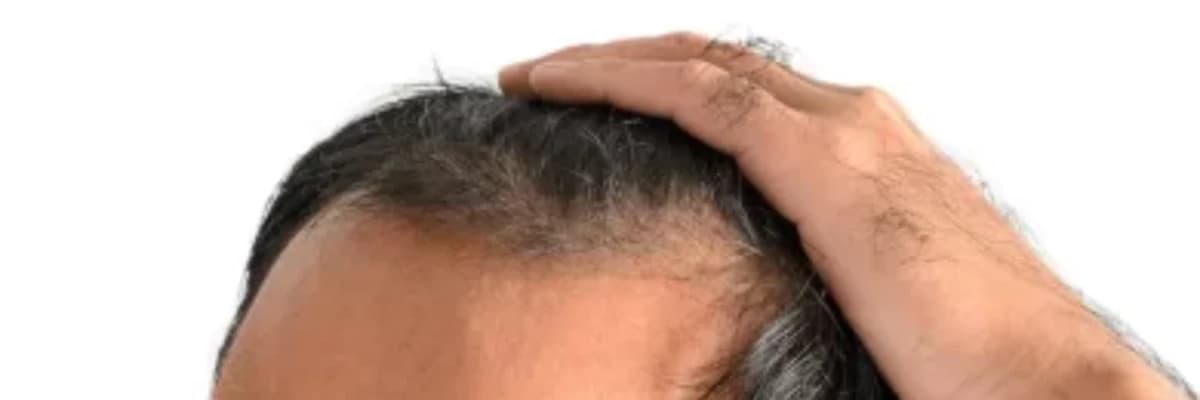 Frontal Lifli Alopesiya: Səbəbləri və Müalicə Yolları